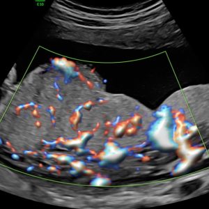 Ultrassom com Doppler